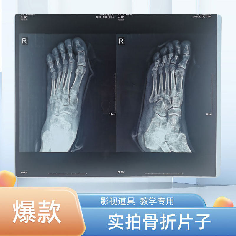 Leg Foot Fracture Sheet Subreal Pat and TV props Teaching Film Waist Gum Hand Lumbar Disc Herniated Disc-Taobao