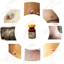 Remove neck filamentous meat monkey skin fat especially small meat balls under the armpits of the body scalp thorn monkey Xiu Zi Ling Cream