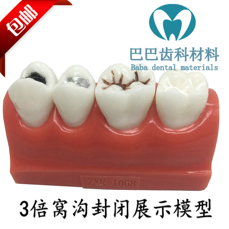 Dental Trench Closure Model Children Mothproof Caries Bad Tooth Model Nest Trench Closed Operation Demonstration 