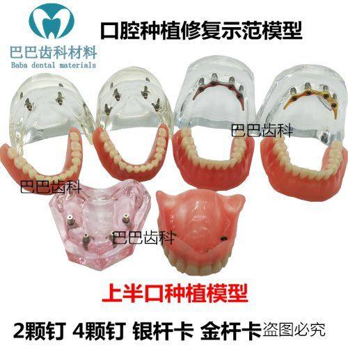 Implant restoration model implant nail ball cap combined with overdenture oral model dental restoration model