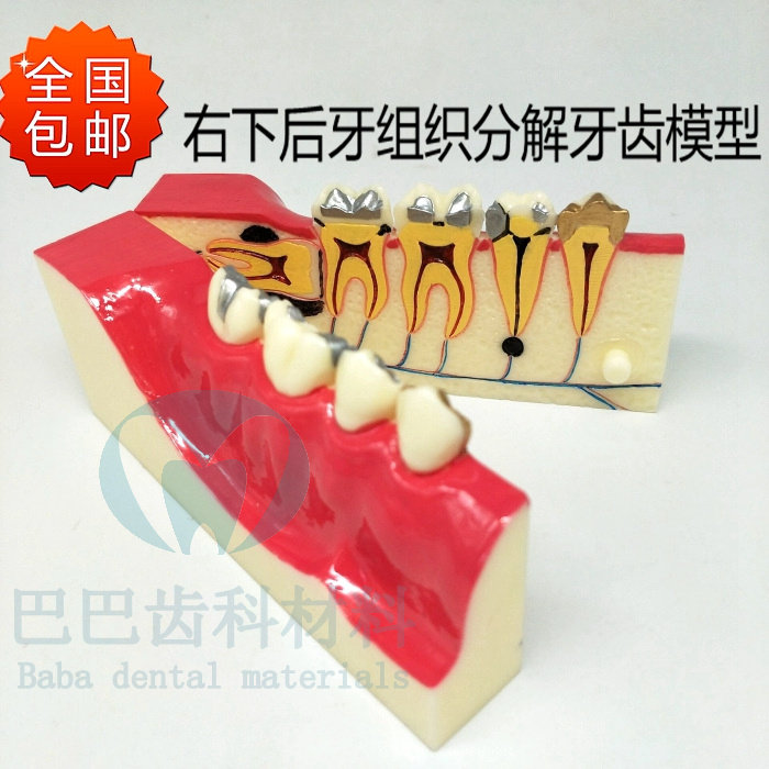 Dental dental model of lower right - back dental tissue decomposition model dental model Dental mold demonstration