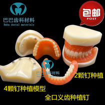 Dental oral model 2 nails full implant nail repair Model 4 nail denture denture display model