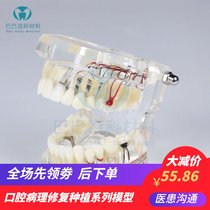 Dentistry Oral teaching Removable implant repair model Movable dental implant Dental doctor-patient communication 