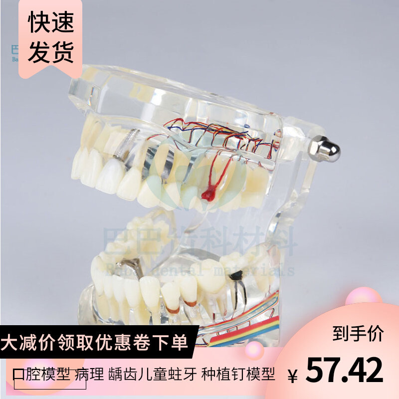 Dental Oral Teaching Detachable Implant Repair Model Active Tooth Cultivation Dental Doctor-patient Communication 