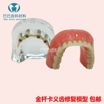 Dental dental model Dental repair model Gold rod card Doctor-patient communication Implant repair 