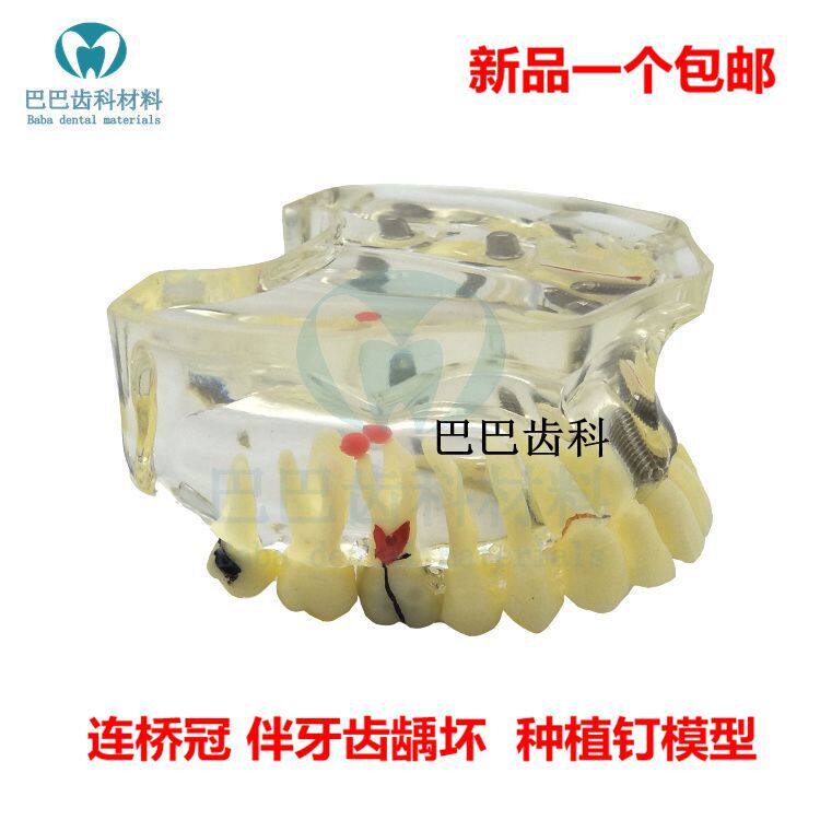 Dental Oral Model Cultivation Repair Half-Mouth Lian Bridge Tooth Carious Model Doctor-patient Communication Teaching 