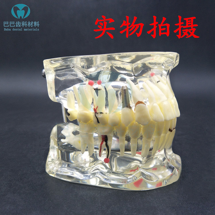 Oral teaching model Crystal transparent adult comprehensive pathological dental model Doctor-patient communication