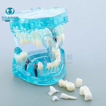 Dentistry Detachable bridge repair model Pathological tooth model Movable tooth Implant model