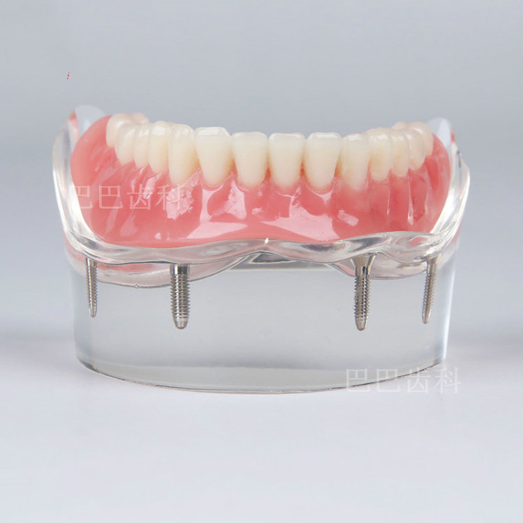 Dental Oral Section Model Medical patient Communication 4 Nail Model New Cultivation and Restoration Model 