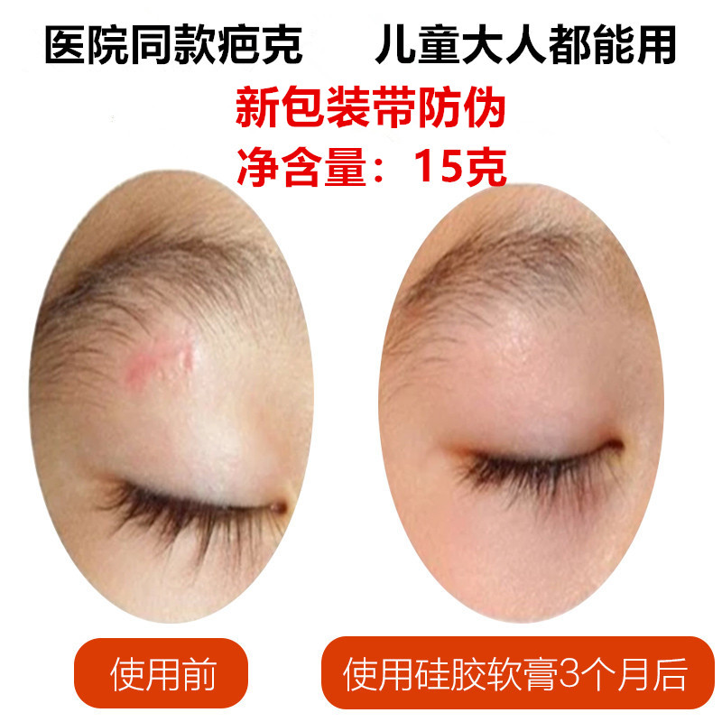 US imports in addition to double eyelid surgery to scarring children silicone gel uneven hyperplasia repair scar cream
