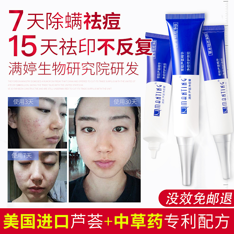 Full Ting Aloe Vera Net Pimple Cream Pimple Acne Clean Pores Aloe Vera de mites Men's official flagship