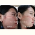 Masseter Essence Face Bone Facial Firming Thinness National National Face Face High Tibial Mandible Facial Lifting Firming 10ml serum vàng Huyết thanh mặt