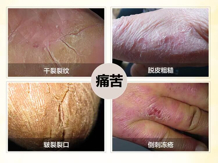 Gót chân khô nứt nẻ nứt nẻ chống chân nứt nẻ dưỡng ẩm dầu ngựa kem dưỡng da tay kem nữ trị nẻ chân