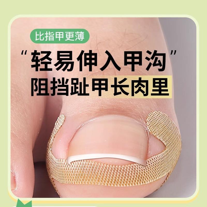 Nail Groove Corrector, Toenail Correction Device, Isolation Pad for Toenails Growing into the Flesh, Correction Patch for Inflamed Ingrown Nails Nail Groove Corrector, Toenail Correction Device, Isolation Pad for Toenails Growing into the Flesh, Correction Patch for Inflamed Ingrown Nails