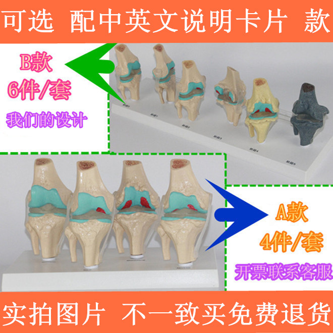 人体膝关节模型病态展示阶段性骨科骨骼模型血友病退行性膝关节病