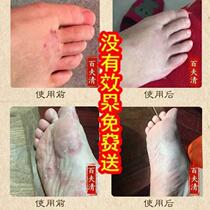 Baifuqing cures itchy peeling feet blisters and sore feet relieves itching and cracked heels°
