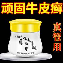 Yinxiaobei psoriasis special Wudu Shencao eczema dermatitis psoriasis scalp ringworm body ringworm hand and foot ringworm to relieve itching