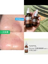 Spot blackhead buster upgraded version synergie reveal blackhead essence to close pores SF