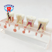 Dental doctor-patient communication Pathological model Endodontic disease treatment repair model display of baby teeth Endodontic decay disassembly