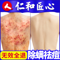 In addition to mite soap the back removes acne and removes mites There are acne marks on the chest the back of the body the back of the back medicine soap sulfur soap