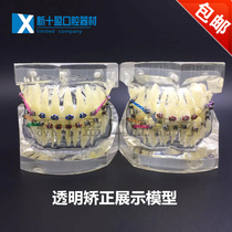 Wrong jaw correction display model Dental teaching model Tass bracket orthodontic oral model Transparent tooth model