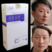 Bangmei Shi acne cream products top five fast to acne acne acne desalination acne acne scar cream male female students