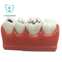 Dental Material Oral Teaching Aids Nest Trench Closed Operation Demonstration Model Doctor-patient Communication 