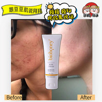 New Zealand biohoney Manuka Honey Acne Cream Natural acne Cream Moisturizing repair 50g