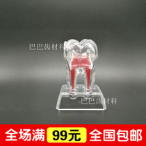 Dental Large Teeth Model Single Removable Pathology Presentation Model 75mm Large Tooth Structure 10