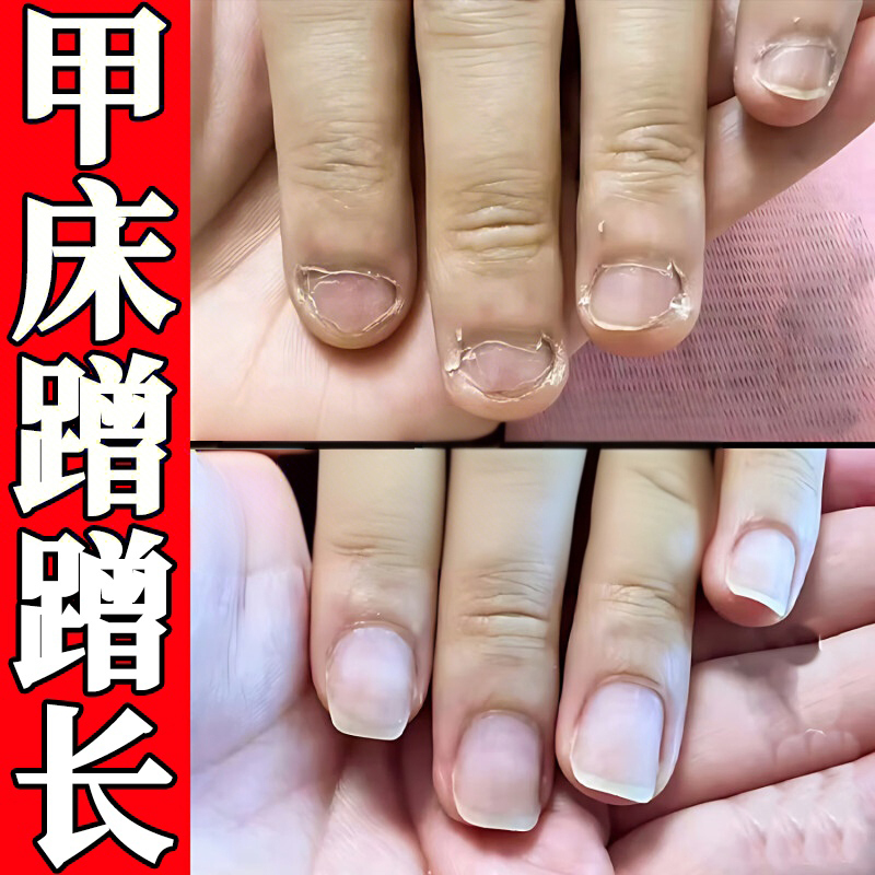 Nail Bed Repair Growth Solution for Damaged and Receding Nails, Regrowth of Nail Flesh, Separation, Hollowing, Cracking, Growth, Nail Care Oil Nail Bed Repair Growth Solution for Damaged and Receding Nails, Regrowth of Nail Flesh, Separation, Hollowing, Cracking, Growth, Nail Care Oil