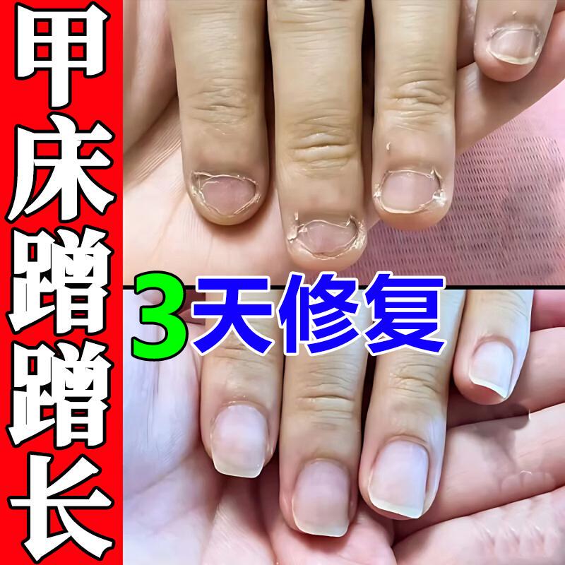 Nail Bed Repair Growth Solution for Damaged and Receding Nails, Regrowth of Nail Flesh, Separation of Empty Nails, Broken Nail Growth, Nail Care Oil