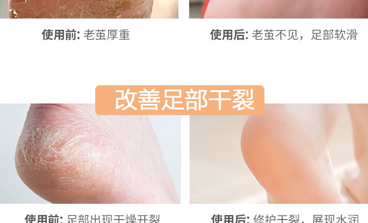 晴 tẩy tế bào chết chân tẩy da chết cũ lột da chân bàn chân chăm sóc chân màng mềm mắt cá chân kem got chan