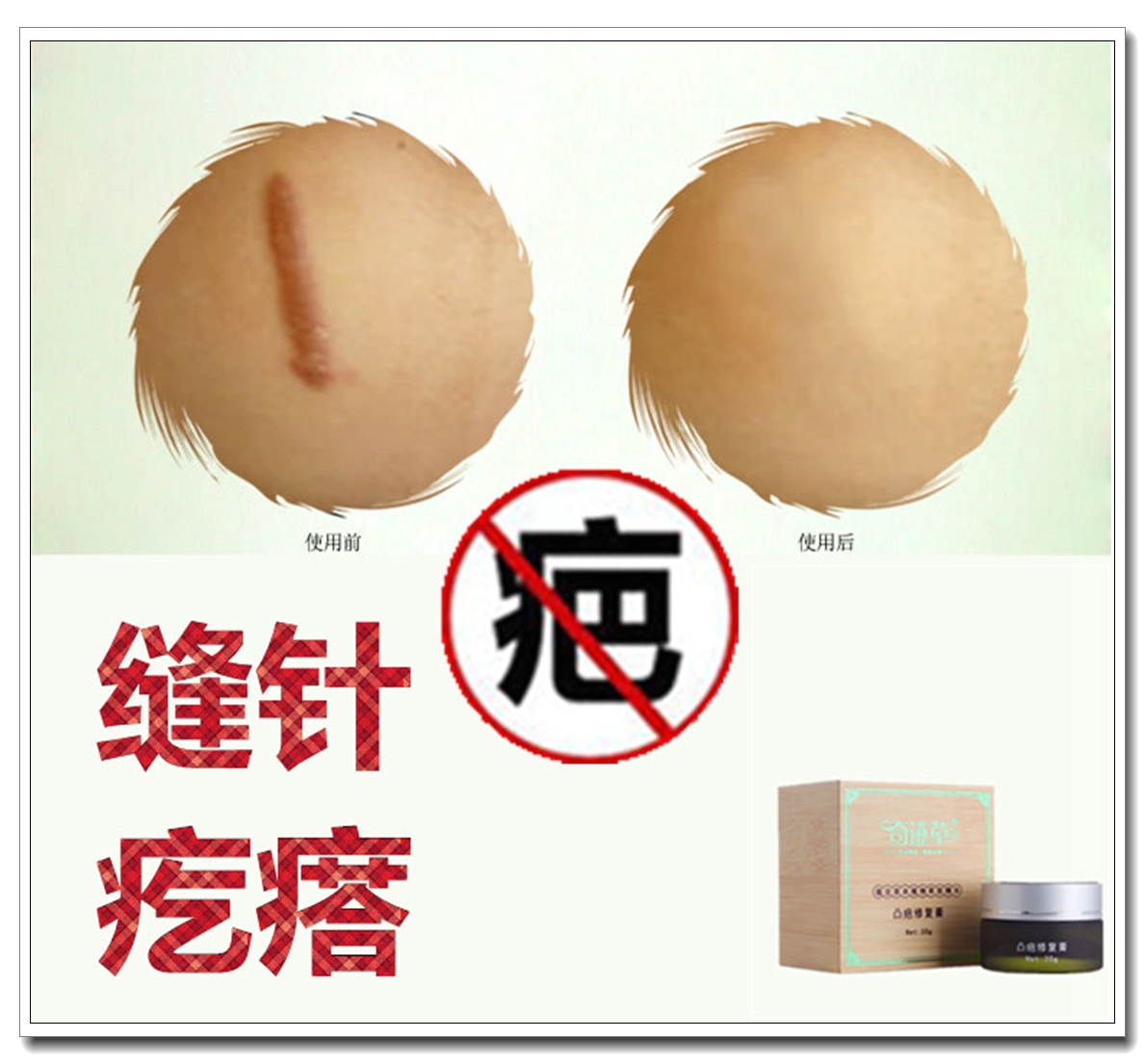 Removal of male and female ear holes bumps to soften the proliferative carb repair bruised and bruised scar physique ointment gel