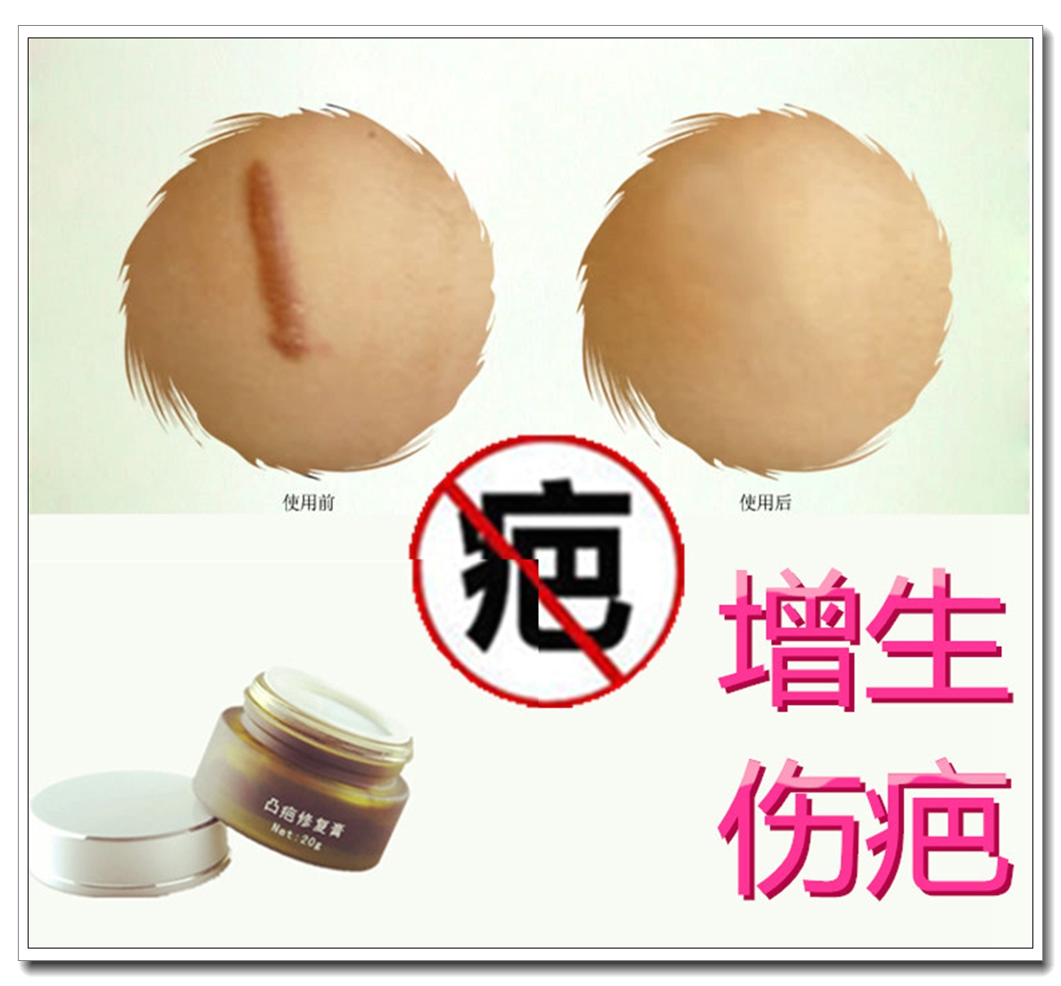Removal of concave bumps hard bumps with flat stickstars to repair proliferative scarring physique ointment to dispel male and female frostbite scars