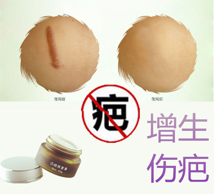 De-proliferative physique, repairing bumps, softening pimples, cutting wounds, Bahenling removal surgery, postpartum bruising medicine