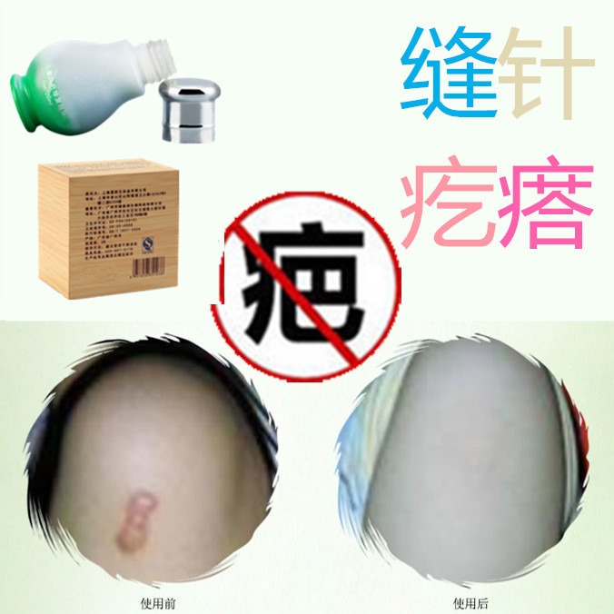 Repair to soften the proliferative physique Bumps to remove the stitches Needle Knife Injury Bout of the Surgical Injury Cream product