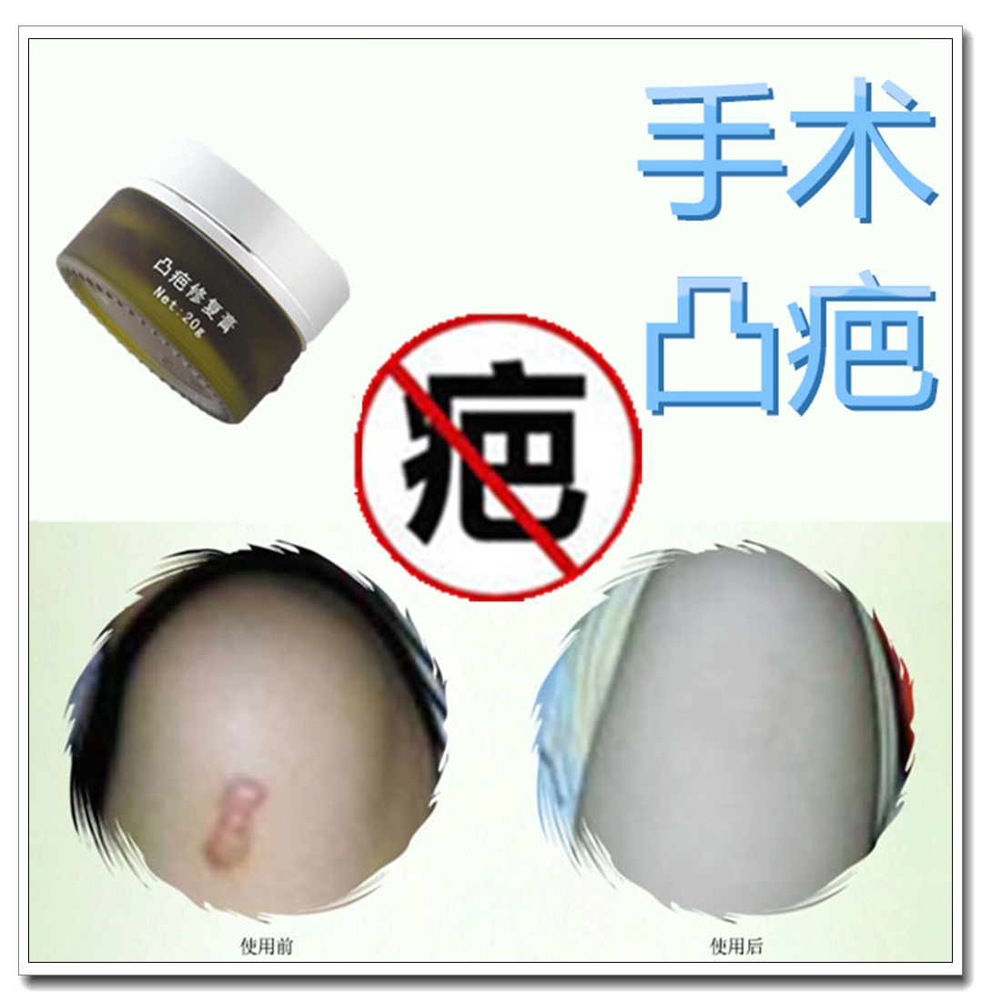 Repairing the ointment for surgical stitches removal of children's face scratches and scalping scarring heart-warming special