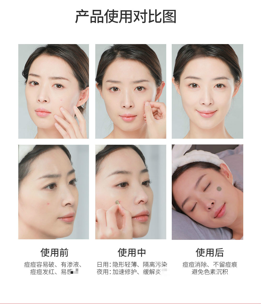 Miếng dán mụn SNP Hàn Quốc tăng cường khắc phục các vết thâm mụn, mụn hút mủ và miếng dán mụn đậu, xóa mụn trong suốt vô hình trang điểm kẹp mi