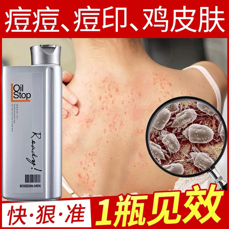 Boston anti-mite shower gel for men and women to remove back acne and itching deep clean oil control shampoo bath two-in-one