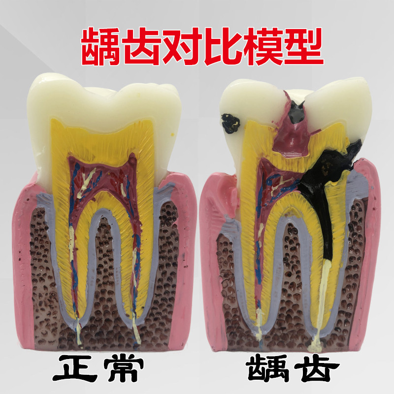 口腔教学模型 6倍龋齿对比模型 医患沟通 口腔模型 牙科模型 包邮