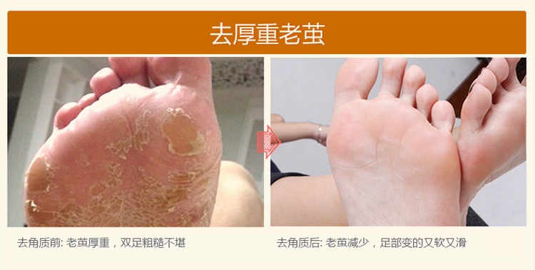 Yalanka Chà Chân Tẩy Tế Bào Chết Kem Chà Kem Chân Tẩy Tế Bào Chết Chân Cũ Feet 200 gam Chăm Sóc Bàn Chân kem dưỡng ẩm tay chân
