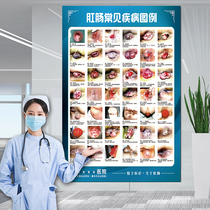 Common anorectal diseases legend wall chart hemorrhoids Anorectal Hospital posters human organ display board poster wall stickers