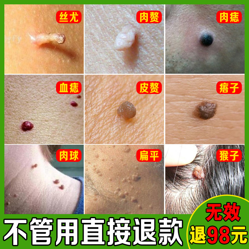 Wart clearing ointment removes small warts and warts on monkeys' necks, a touch of worry-free filiform warts on the neck