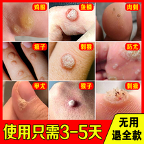 Special medicine for removing meat thorns and fish scale moles to remove monkey meat pimples on feet and hands