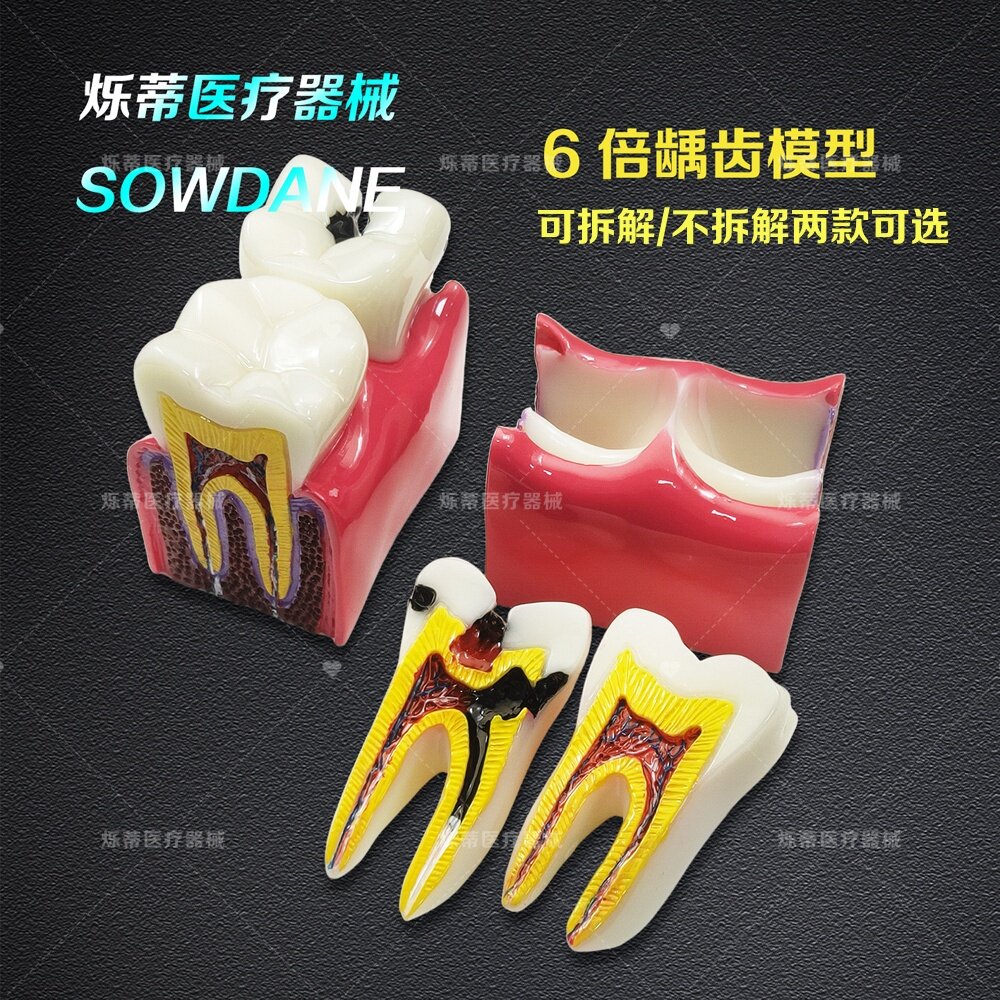 牙科模型 6倍比例龋齿和正常牙齿对比牙模 横截面牙齿分解模型