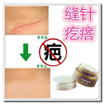 Repair hypertrophic constitution remove surgical scars remove facial scars scars and prints for men and women remove chilblains discoloration smoke and burn patches