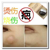 Remove proliferative softening burns bumps pimples bruises melanin smoke burn scars repair cream
