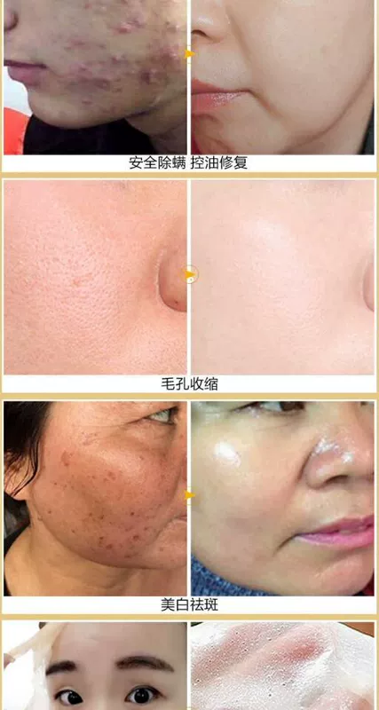 Yêu làn da nên dưỡng ẩm sâu làm đẹp da mặt 120g dưỡng ẩm trắng loại bỏ da chết mặt nạ sừng đen. - Mặt nạ
