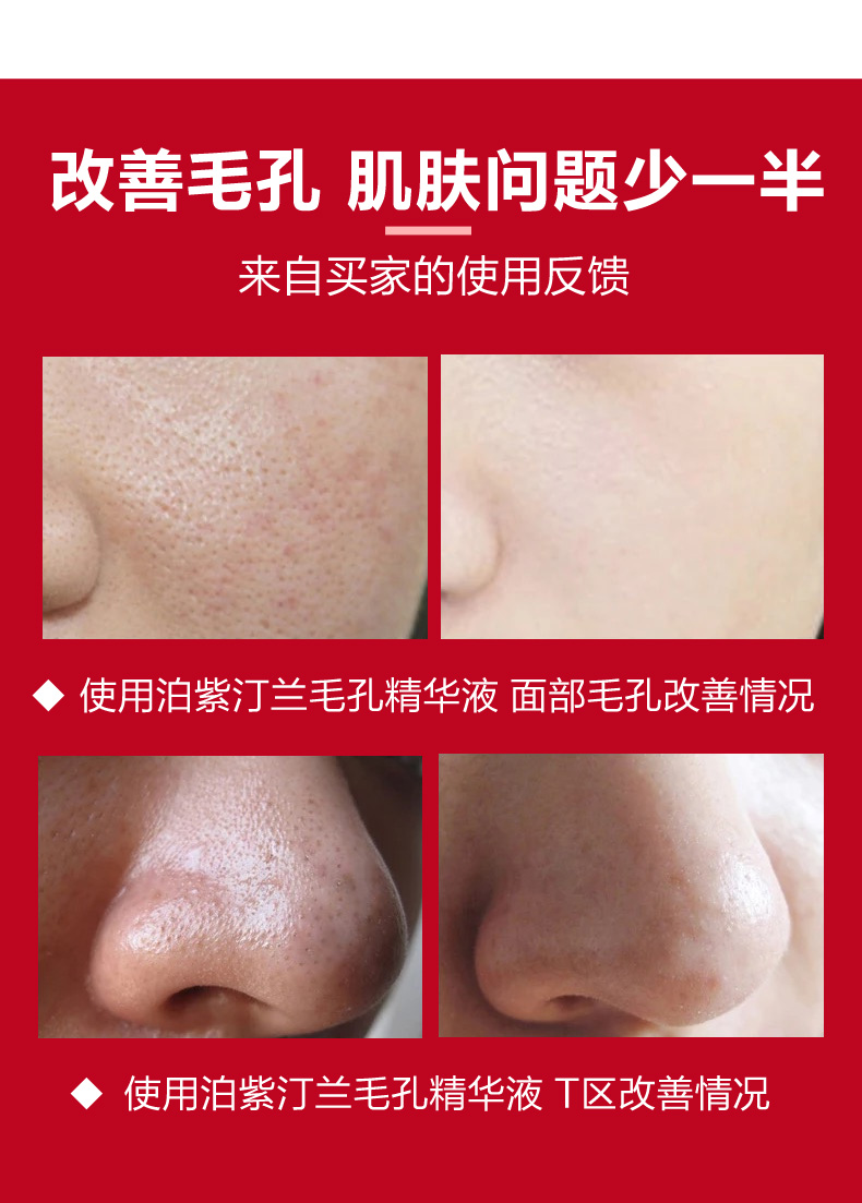 Mua một tặng hai! Thu nhỏ lỗ chân lông, se khít lỗ chân lông, sửa chữa lớn, nam và nữ, trị mụn đầu đen tinh chất rau má madagascar