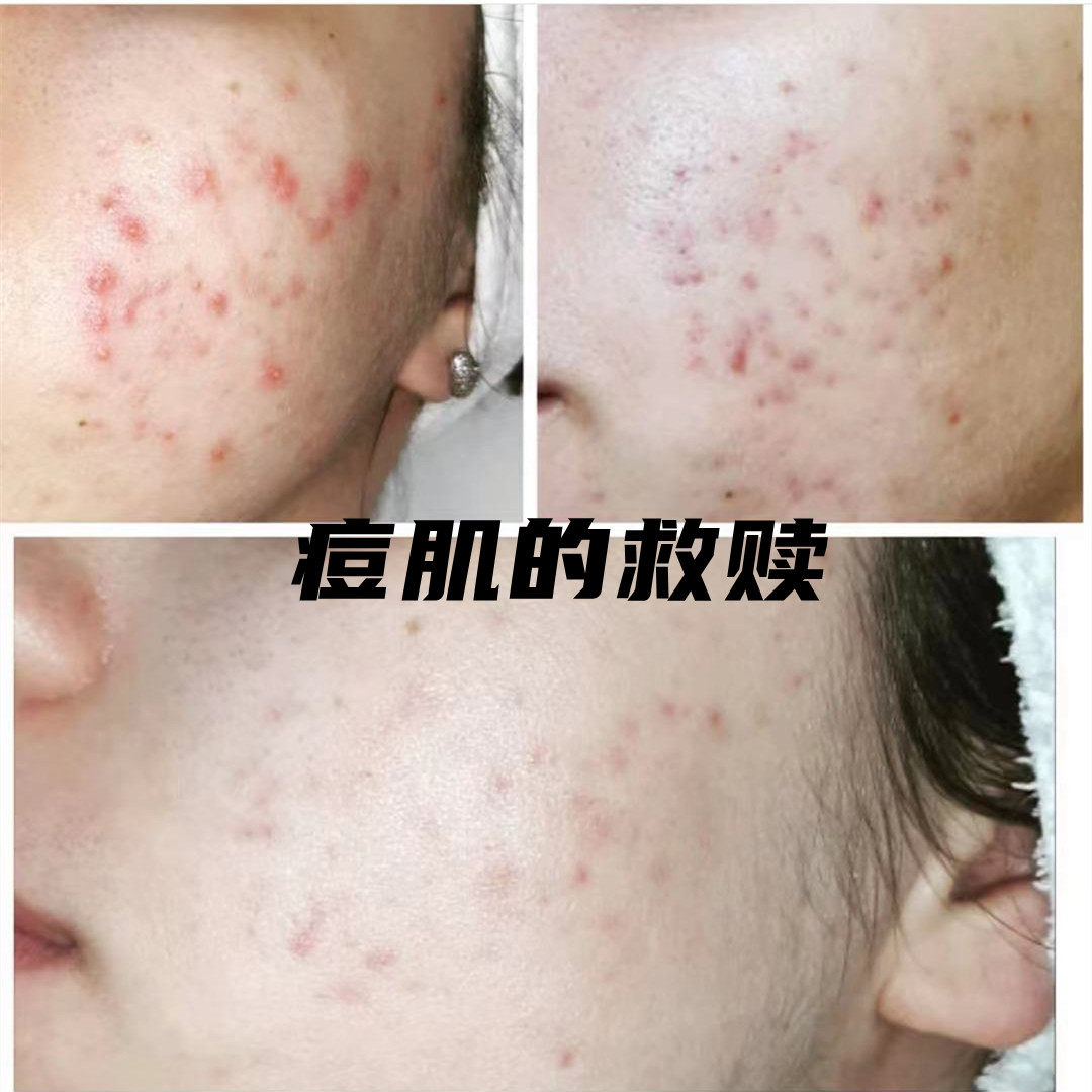  What I would like to call the salvation of the magic pimples ~ babor acne-Anbottle